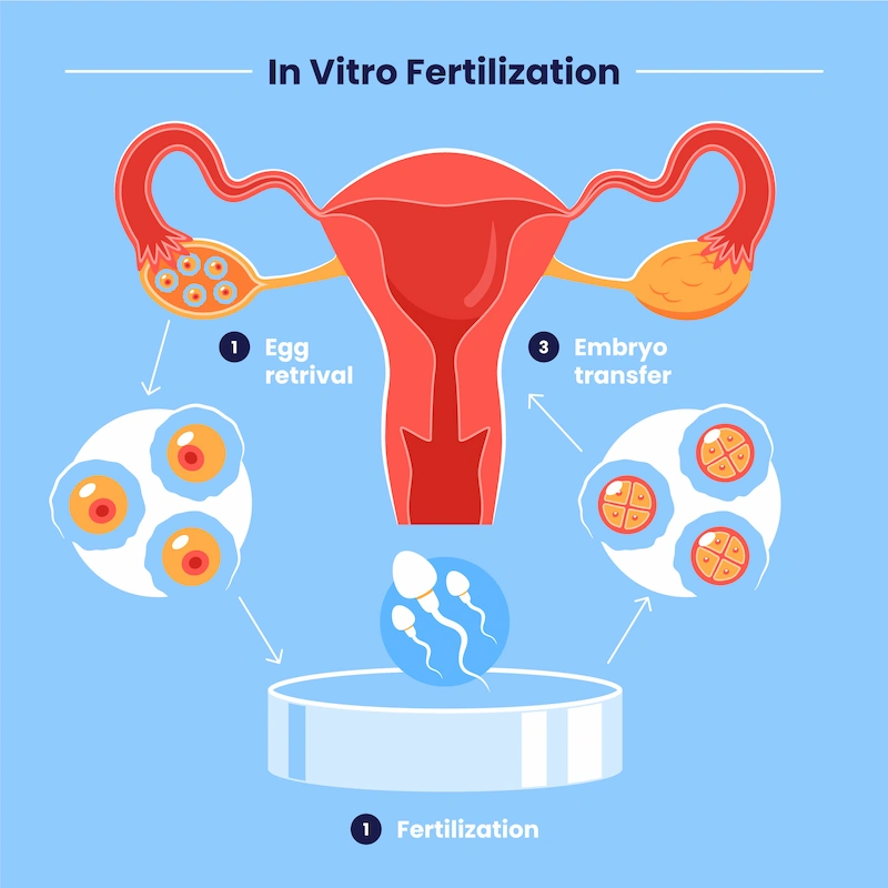 جامعترین راهنمای IVF با اسپرم اهدایی